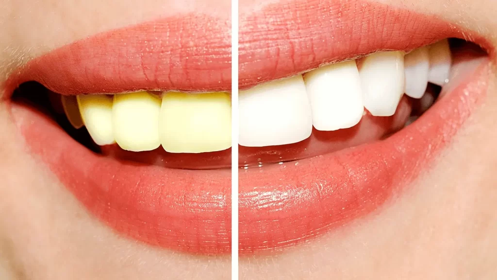 Clareamento Dental em Londrina