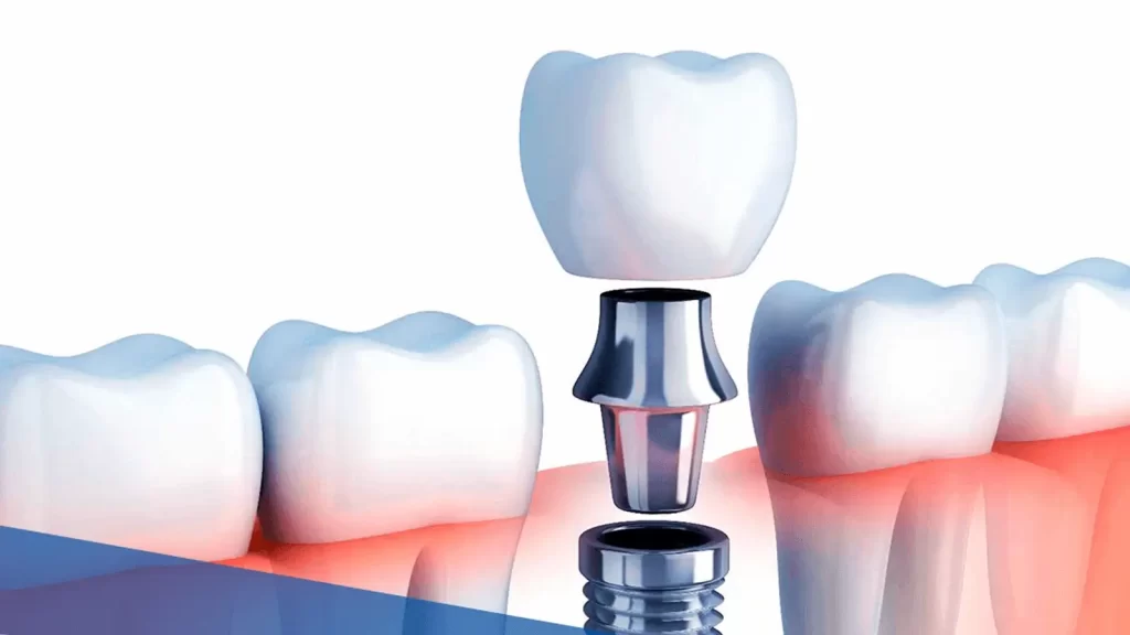 Implante dentário em Londrina