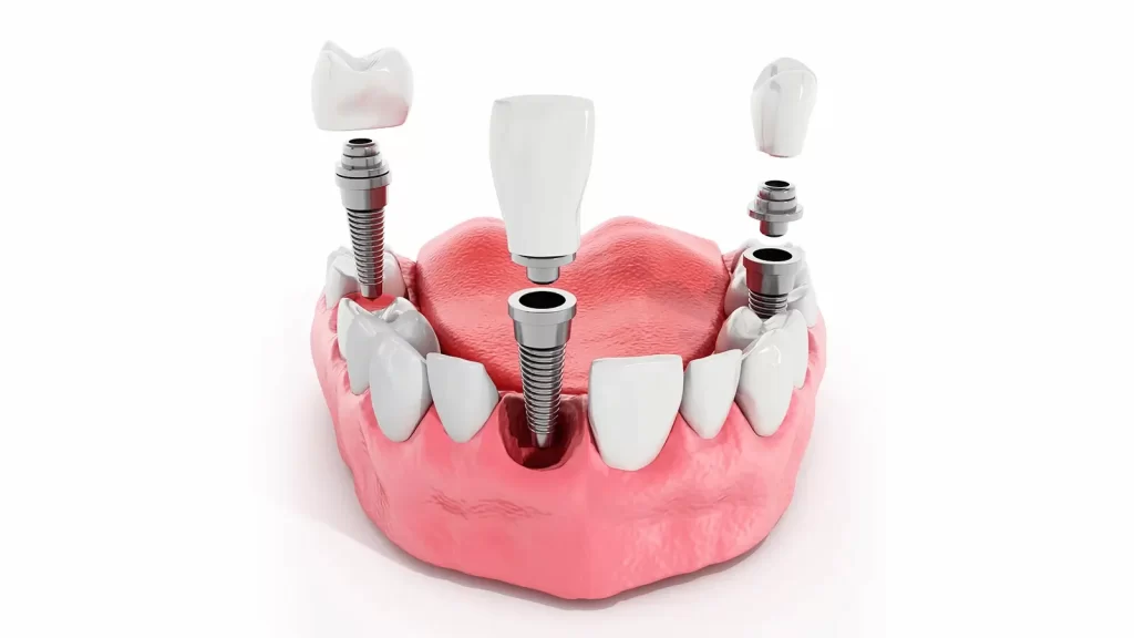Implante dentário em Londrina